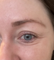 Is Botox the best thing for around the eyes?