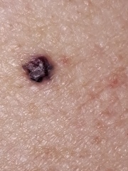 Moles - suspicious?