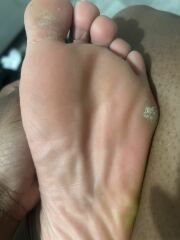 Is this athletes foot ?