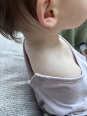 Rash on 13 month old