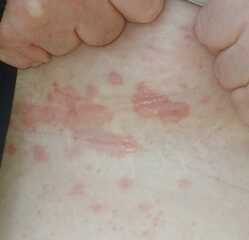 Rash help please