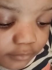 Baby just hit the bridge of his nose on side table (photo) 
