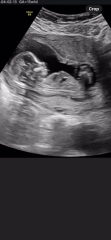 15 week scan gender guesses?