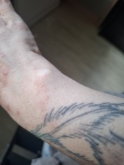 Hand infected (Warning, gross photos)