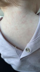 Rash on 13 month old