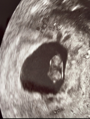 Can someone decipher my ultrasound please?