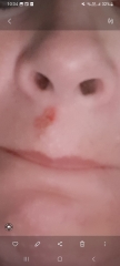 Cold sore or something else