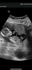 15 week scan gender guesses?