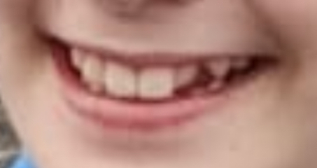 DD missing one lateral incisor