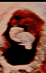 8 week scan query
