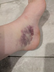 To go to minor injuries tomorrow?