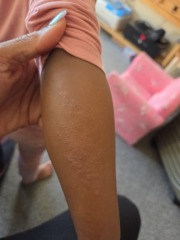 Does this rash on my 3 yr old look familiar?