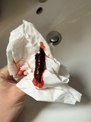 Is this a miscarriage? Or a SCH?