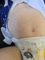 Opinions on this rash please (pics)