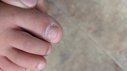 Fungal toenails, 8yo