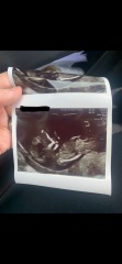 12 week scan gender guesses