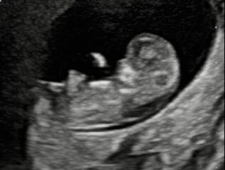 Nub theory - boy or girl ?