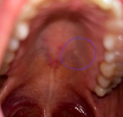 Any dentists about or GPs? Small hard lump roof of mouth