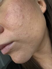 Breakouts at 30.. help 😭