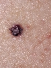 Moles - suspicious?