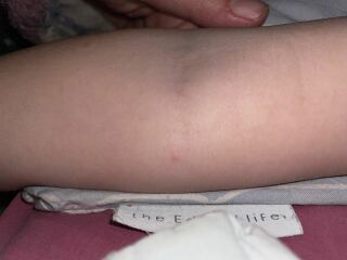 If it isn’t chicken pox, what is it?