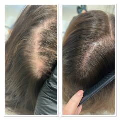 Female hair loss - please help