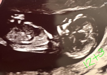 Medical mystery - Very big nuchal fold disappeared within three days
