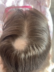Bald spots on my 3.5 year old girls head