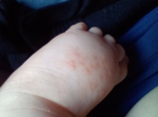 Rash on 5 month old's feet