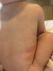 Baby rash