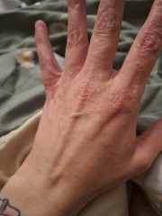 Hand infected (Warning, gross photos)