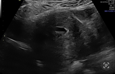 Pregnancy scan