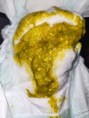 Teething poop or milk allergy??