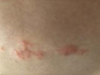 14yo has very bad rashes/bumps