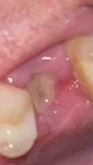 Does my tooth extraction look to be healing ok? Grim picture included