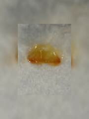 Can you blow a nasal polyp out? 