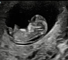 Nub theory - boy or girl ?