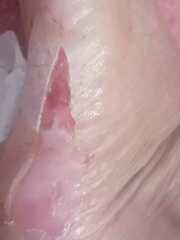 Burst, painful blister..PHOTO ATTACHED