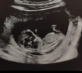 Has anyone been told the gender at 12 week scan?