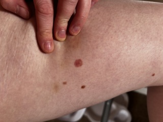 Itchy big mole.. HELP!