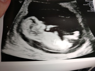 Nub/Gender from 12 week scan?