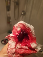 GRAPHIC PICS - Is this a miscarriage