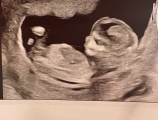 Nub theory, boy or girl?