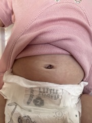 Does my baby’s belly button look normal?