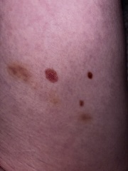 Itchy big mole.. HELP!