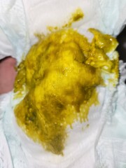 Teething poop or milk allergy??