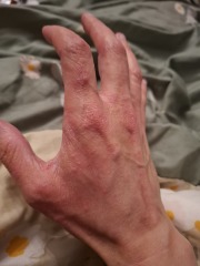 Hand infected (Warning, gross photos)