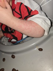 Opinions on this rash please (pics)