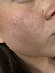 Breakouts at 30.. help 😭