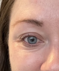 Is Botox the best thing for around the eyes?